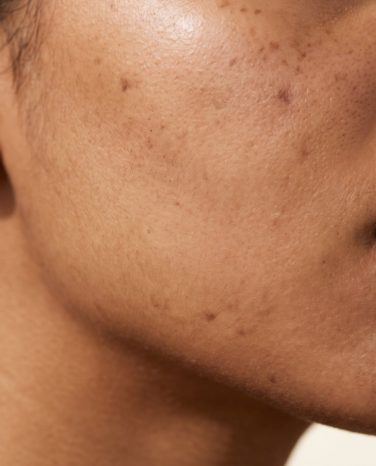Close-up of a person's face with acne scars and text about kojic acid treatment.